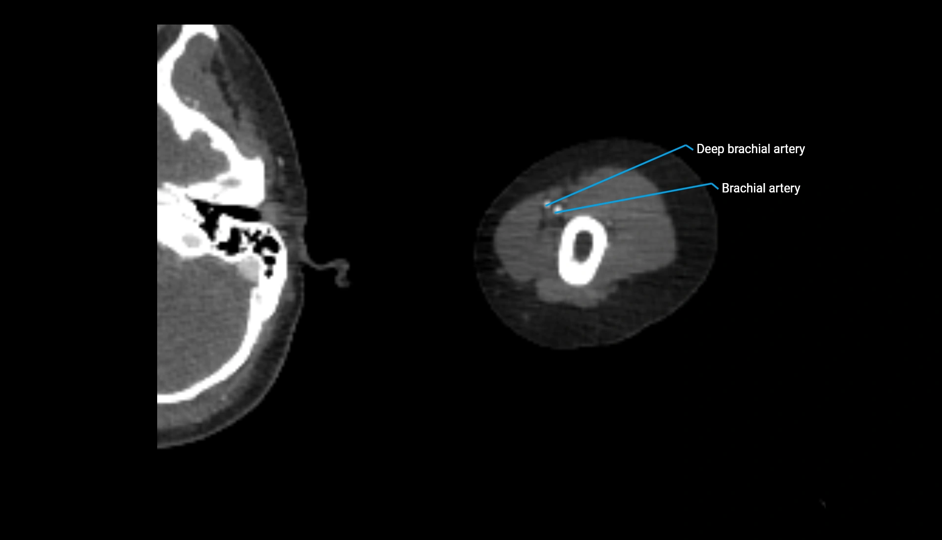 CTA upper limb axial cross sectional anatomy labelled image 263 (2).webp